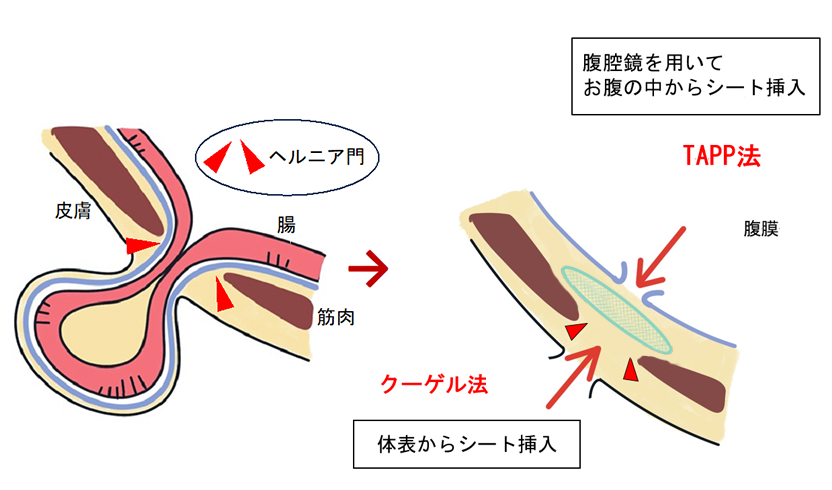 tapp法